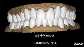 exocad with Walid Mansour 00201005587414 EgyptCairo [upl. by Ahsinirt]