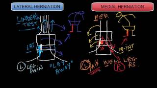 Lateral vs Medial Disc Herniations [upl. by Archy]