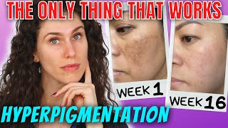 The ONLY Ingredients That Stop Hyperpigmentation And Reverse It [upl. by Cand495]