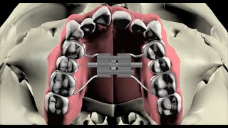 Are maxillary palatal expanders overused [upl. by Sabine489]