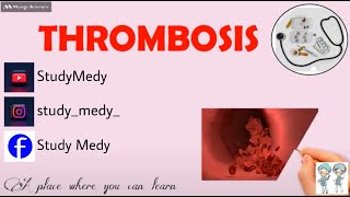 Thrombosis PathologyDefinitionCauses of thrombosisVirchows triadPathogenesisBlood clot [upl. by Eibrad]