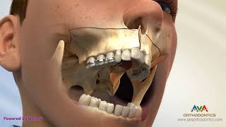 Surgical Orthodontic Treatment for Constricted Upper Jaw  SARPE [upl. by Refinej243]