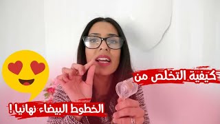 كيفية التخلص من الخطوط البيضاء نهائيا😍 بعد الولادة 😱 [upl. by Esenej781]