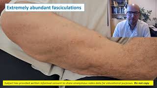 Needle EMG fasciculations [upl. by Zischke]