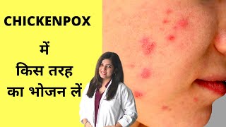 Best Foods For Chickenpox चिकन पॉक्स में किस तरह का खाना खाएं [upl. by Seko541]