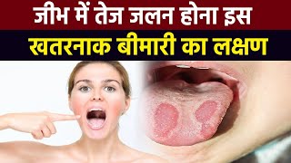 जीभ में जलन होना Burning Mouth Syndrome Symptoms क्या हैं बचाव  Boldsky [upl. by Zailer156]