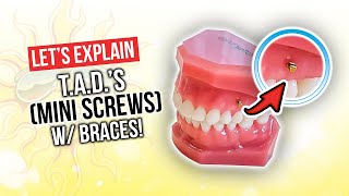 How Long Will You Need TADs With BRACES For [upl. by Jacintha]