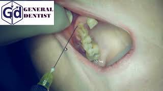 Infiltration anesthesia for extraction 12 tooth [upl. by Terza]