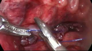 THORACOSCOPIC REPAIR OF TYPE C ESOPHAGEAL ATRESIA [upl. by Nahtanoy]