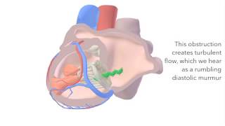 Mitral Stenosis  sound amp animation [upl. by Ylhsa]