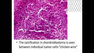 Chondroblastoma shows Chiken wire calcification [upl. by Elleret227]