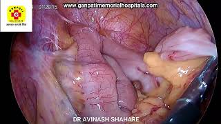 STEPS OF LAPAROSCOPIC HYSTERECTOMY SHARING OUR EXPERIENCES DR AVINASH SHAHARE DR SHWETA SHAHARE [upl. by Hgeilyak]