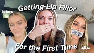 Getting Lip Filler for the First Time  What It Looks Like Months Later [upl. by Ijok]