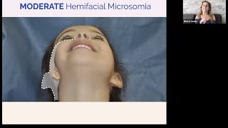 Live Chat Hemifacial Microsomia and PIER for Microtia [upl. by Annid292]