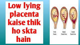 low lying placenta कैसे ठीक हो सकता है low lying placenta risk and precautions [upl. by Ijar]