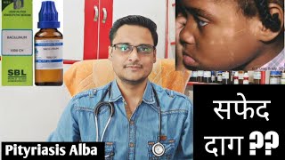 Pityriasis alba homeopathic treatment  explain चेहरे पर सफेद दाग [upl. by Butte321]