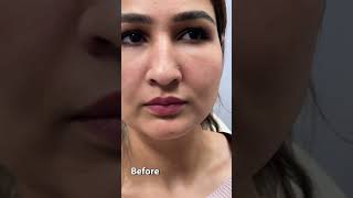 Lip Filler Before and After To Enhance Natural Beauty lipfillers lipfillerbeforeandafter beauty [upl. by Majka]