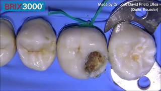 Caries removal with Brix 3000 enzymatic gel [upl. by Wescott423]