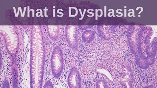 What is Dysplasia  Pathology mini tutorial [upl. by Yeltrab]