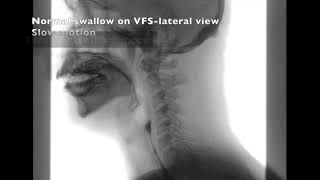 Normal Swallowing on Lateral View Videofluoroscopy Krishnakumar Thankappan [upl. by Walczak218]