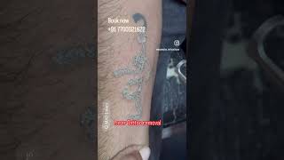 ⁠ madinkers lasertattooremovalspecialist lasertattooremoval youtubeshorts youtube reels [upl. by Drain425]