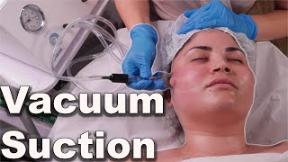 Vacuum suction facial treatment  avoid pore bruising step by step demo 2021 [upl. by Notsuoh843]