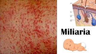 Miliaria Heat rash [upl. by Covell]