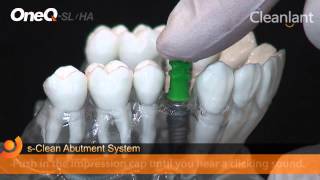 Sole Abutment  DENTIS Implant [upl. by Anirbys692]