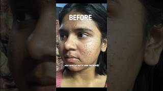 How to use Tretinoin Cream for most effective results Tretinoin before and after skin transformation [upl. by Edouard]