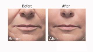 Botox vs Dermal Fillers [upl. by Cissy]