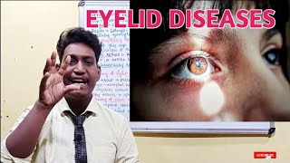 diseases of eyelids entropion and ectropion eyelid diseases 2021 [upl. by Llehsram]