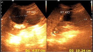 Renal cortical cyst  Milk of calcium cyst  Renal calcification [upl. by Angeline]