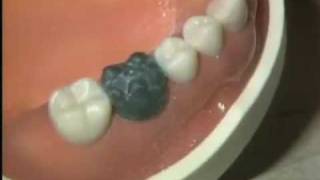 Waxing a Mandibular First Molar Crown [upl. by Seek949]