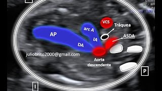 Arteria Subclavia Derecha Aberrante ASDA [upl. by Gwenny]