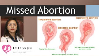 Missed abortion WHY  silent miscarriage [upl. by Woodall]