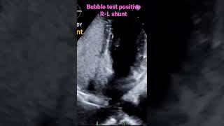 Positive bubble test LR shunt [upl. by Gere]