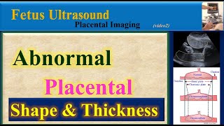 Fetus Ultrasound Abnormal Placental Shape and Thickness [upl. by Paz]