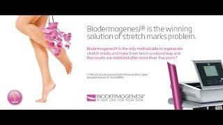 Biodermogenesi solution to stretch marks follow up after 5 years [upl. by Glynas]