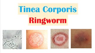 Ringworm Tinea Corporis  Causes Risk Factors Signs amp Symptoms Diagnosis and Treatment [upl. by Berkin229]