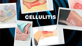 Cellulitis Symptoms and Homeopathic Treatment [upl. by Adela486]