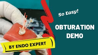 Obturation Made Easy ENDODONTICS DEMO [upl. by Hafler352]