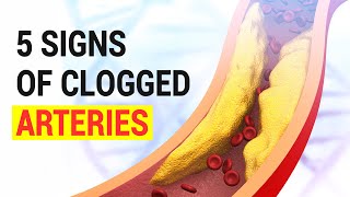 5 Signs Of Clogged Arteries [upl. by Hedgcock]