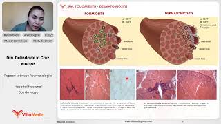 POLIOMIELITIS  DERMATOMIOSITIS  REUMATOLOGÍA  VILLAMEDIC [upl. by Anialeh]