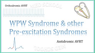 WPW Syndrome amp other preexcitation syndromes [upl. by Esinek296]