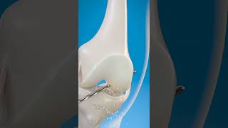 How doctor treat the ligament problem shorts goodscience [upl. by Pradeep]