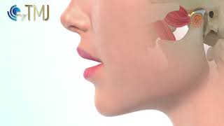 Jaw clicking TMJ disc displacement with reduction [upl. by Rupert]