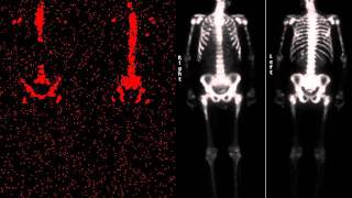 SDS and Bone Scintigraphy [upl. by Herries]