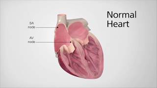 Introduction to Atrial Fibrillation with Electrophysiologist Dr Kamal Kotak [upl. by Doowyah]