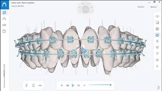 Brackets de autoligado Smile System [upl. by Fidelis]