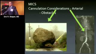 Perfusion Cannulation and Myocardial Preservation Strategies Eric R Skipper MD [upl. by Niki645]